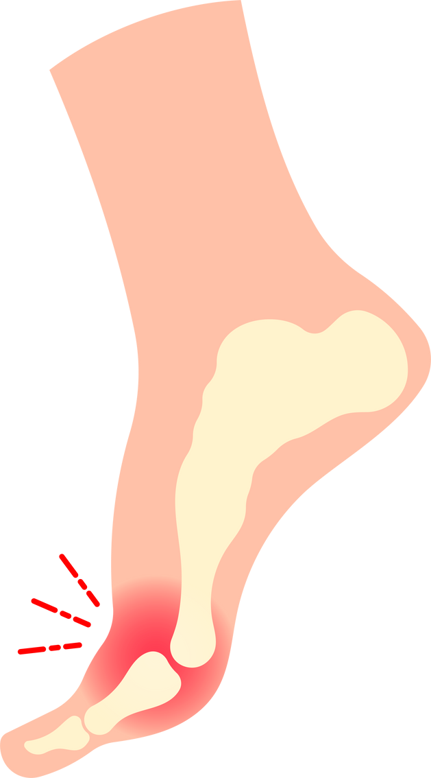 metatarsalgia plantar fasciitis Morton fracture sesamoiditis neuropathy arthritis feet metatarsus flatfoot painful intermetatarsal neuroma bone pain Flatfeet nerve foot bunion metatarsal flat injury toe high heel