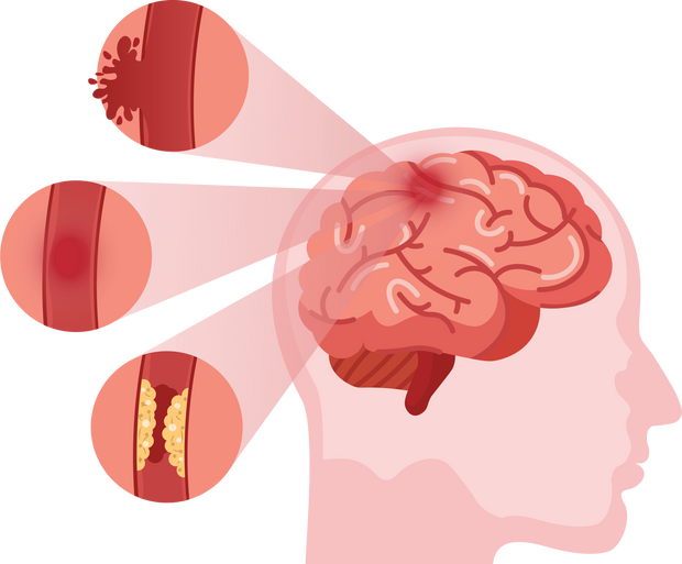 Stroke disease. Hemorrhagic brain stroke concept. Apoplexy,